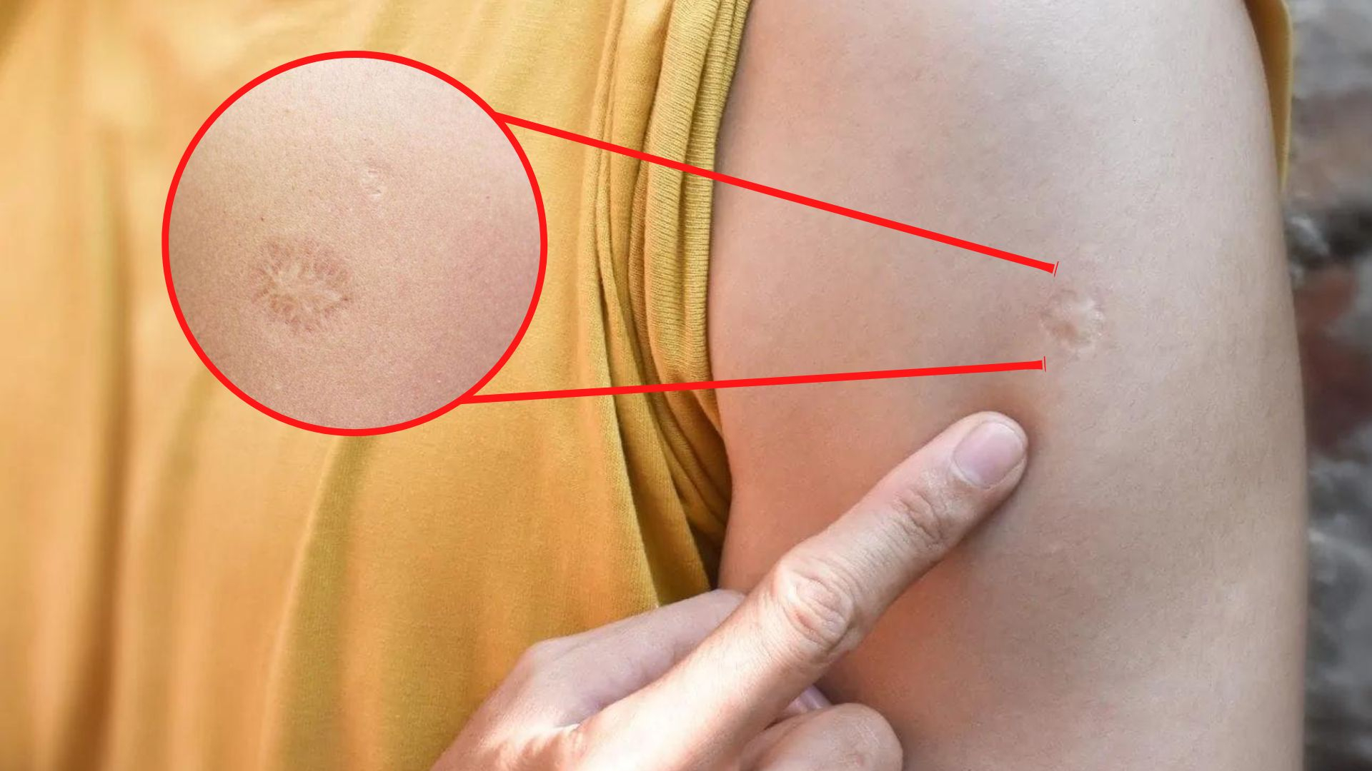 La cicatriz en tu brazo y la historia detrás de la vacuna que cambió al mundo