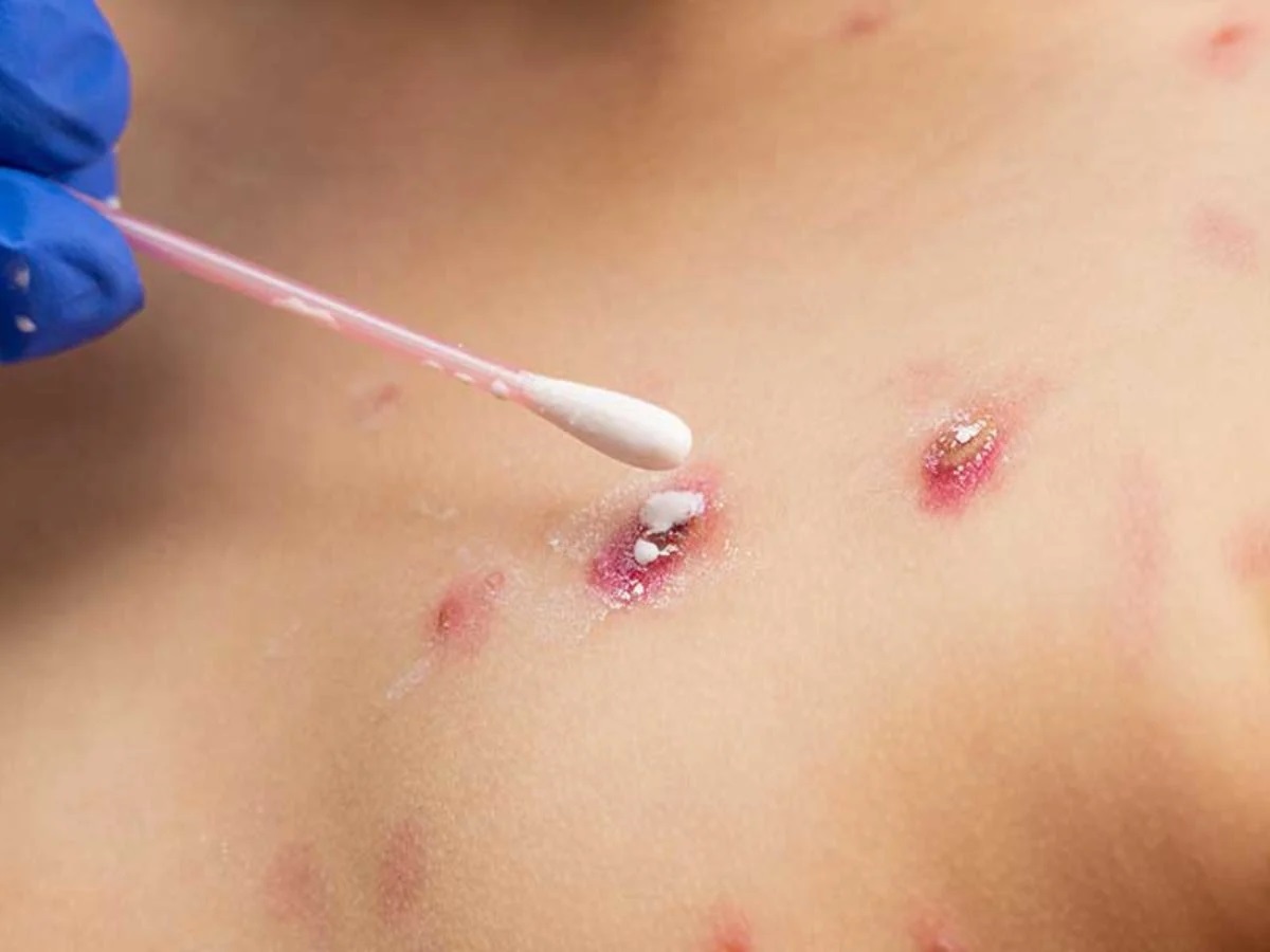 Toma De Muestras En Lesiones Cutaneras Foto De Ilustracion