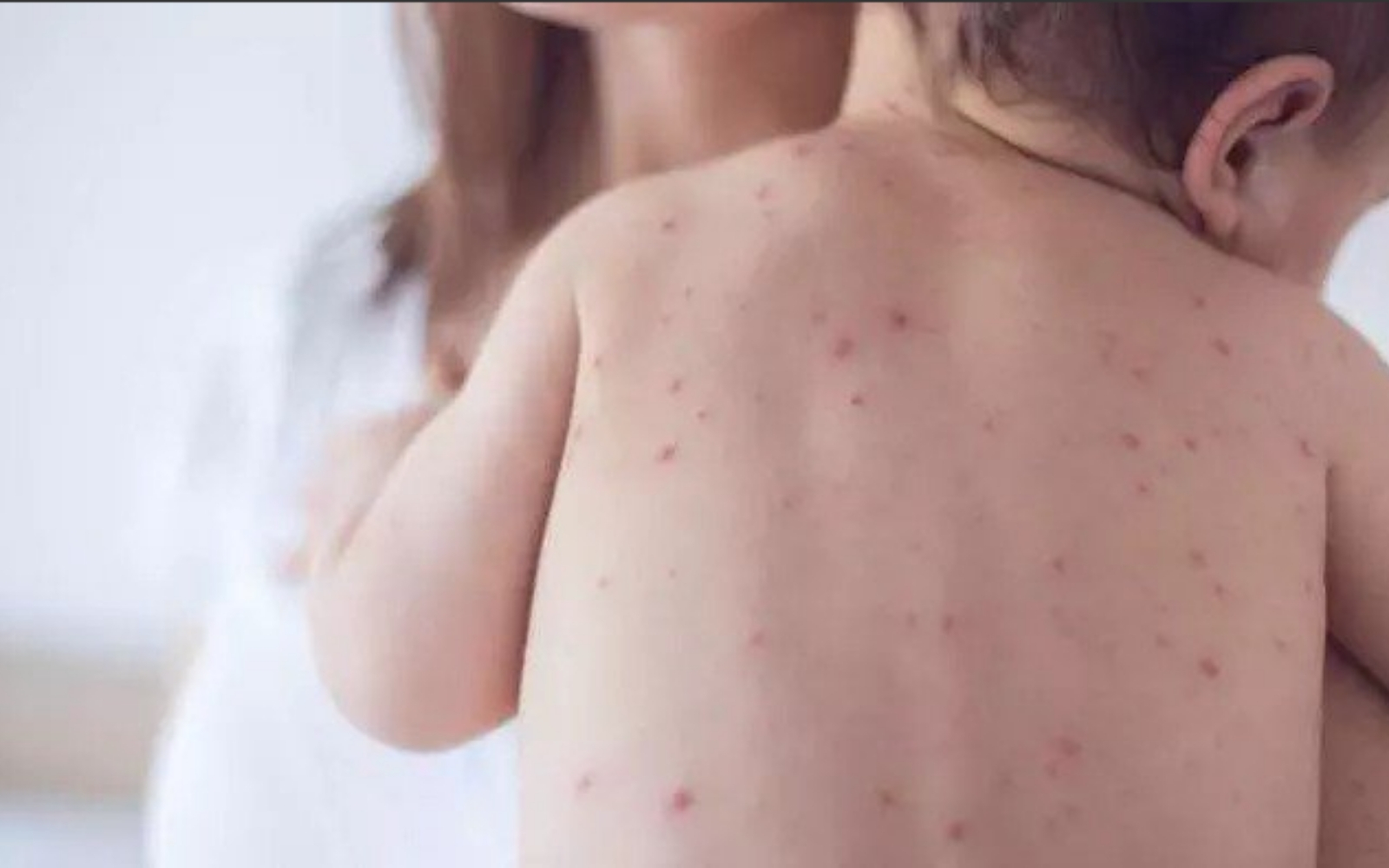 Alerta OMS por brotes de sarampión en el mundo