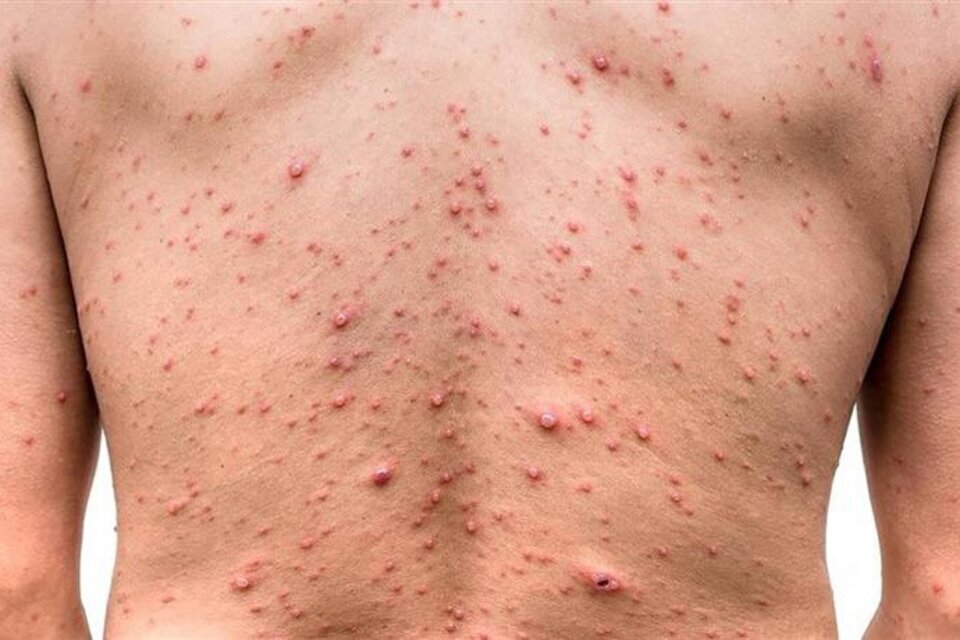 Alerta En Quintana Roo Siete Casos De Viruela Del Mono