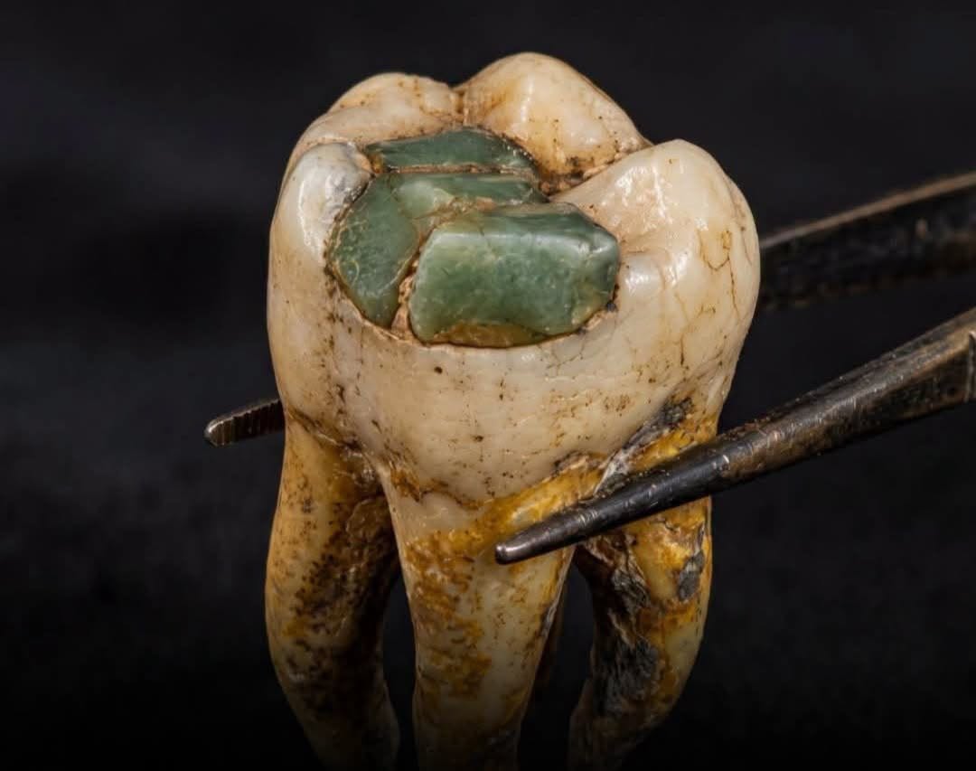 La odontología prehispánica al descubierto: dentistas mayas usaron jade para curar caries y las piezas siguen intactas un milenio después la revista del sureste mx Primer Plano De Un Mular Humano Antiguo Sujetado Con Pinzas, El Cual Muestra Una Incrustación De Piedra De Jade Verde Perfectamente Ajustada En La Superficie Oclusal, Evidencia De Las Técnicas Avanzadas De Odontología Maya Y Modificación Dental Prehispánica.